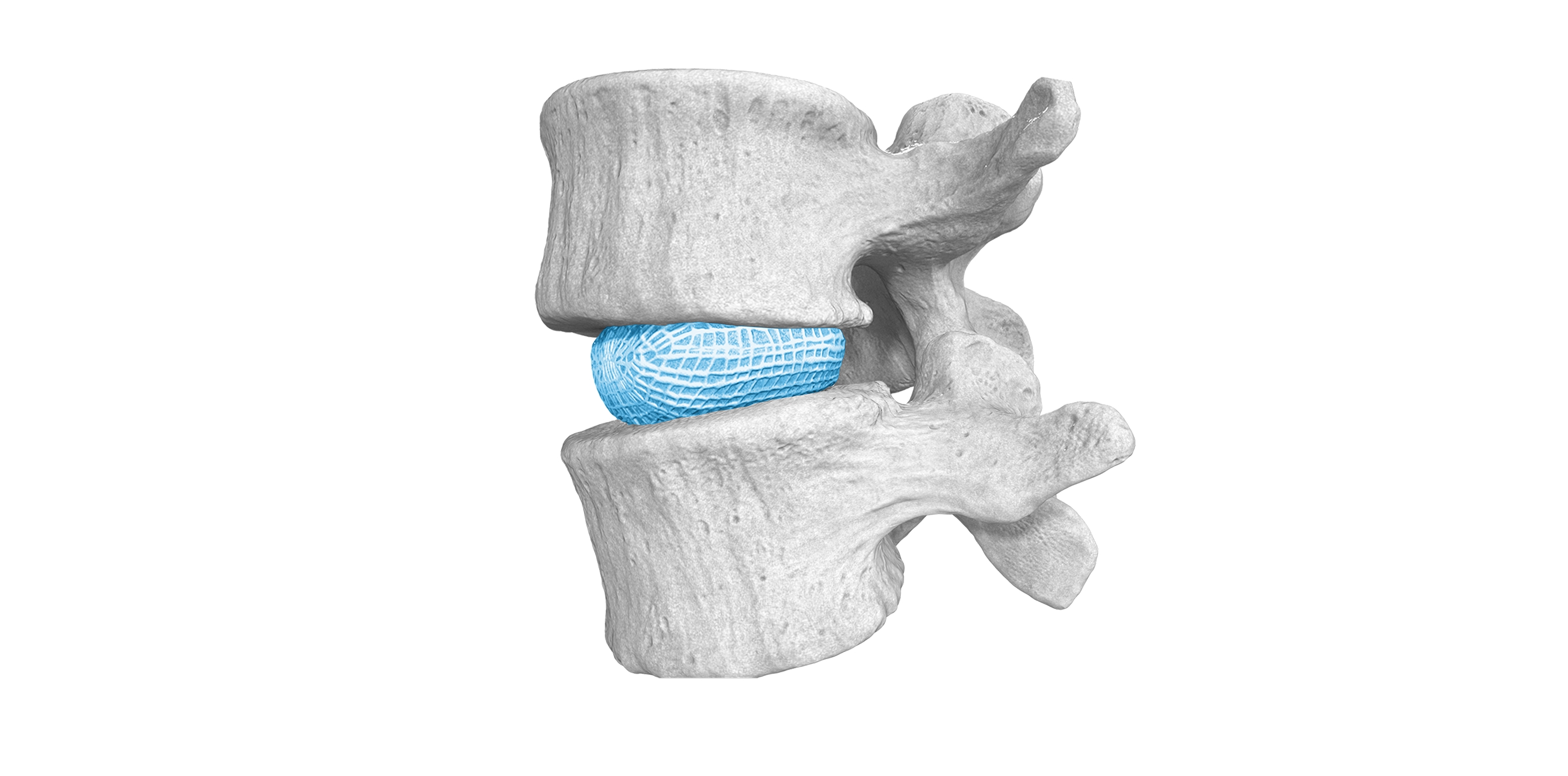 Illustration of two vertebrae with a blue mesh intervertebral implant in the disc space.